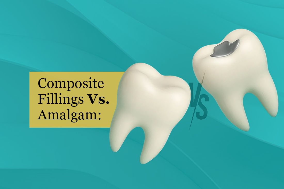 Two model teeth compared: one tooth-coloured filling, one metal amalgam