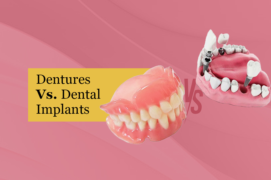 A full denture beside an implant-supported arch for comparison
