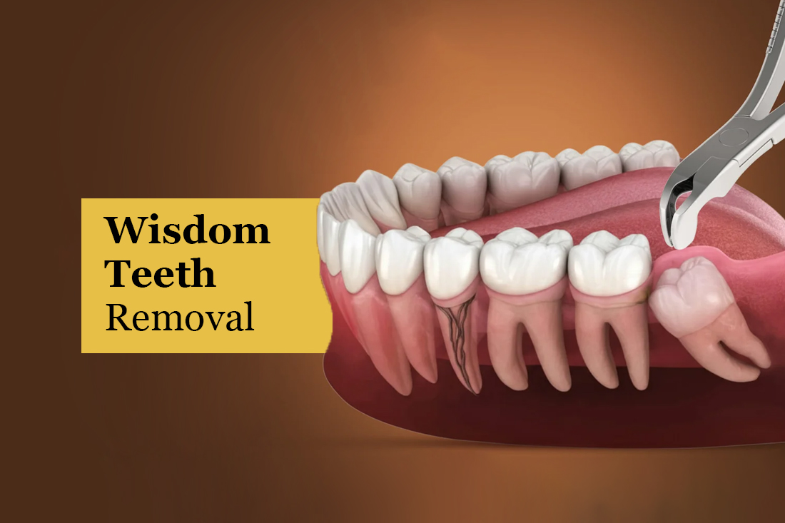 Illustration of a wisdom tooth being extracted from the lower jaw