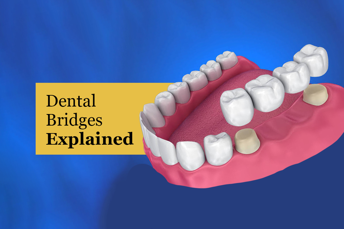 Illustration of a dental bridge spanning a missing tooth