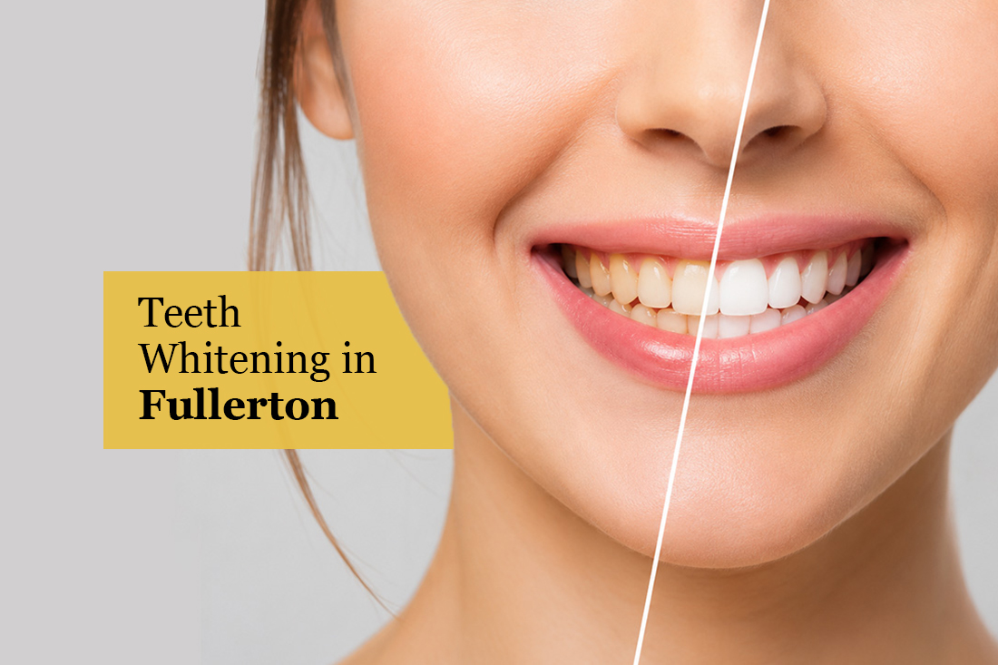 Before and after comparison of a whitened smile