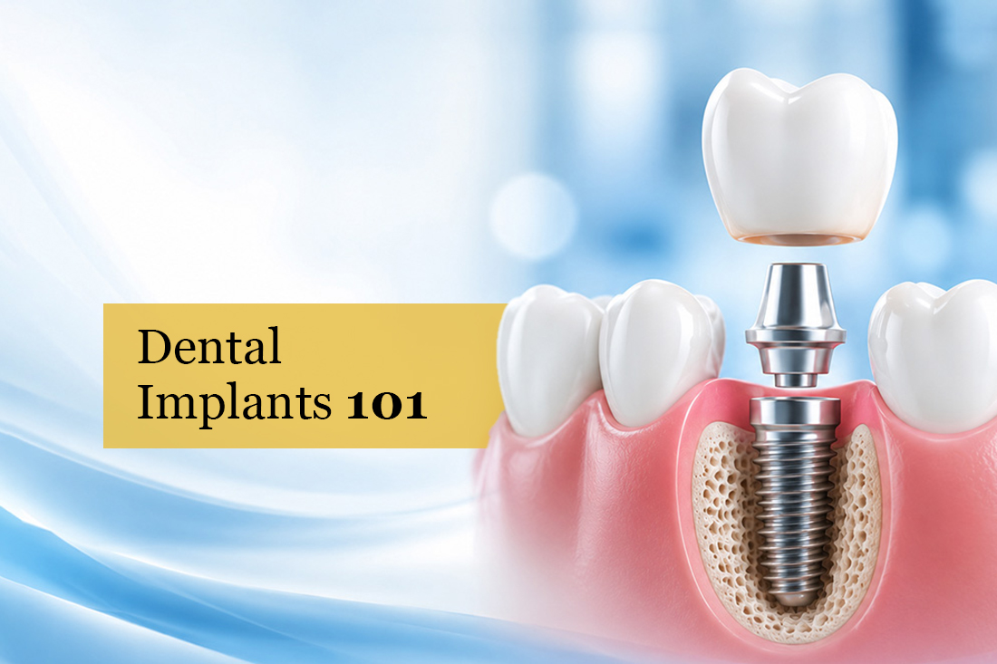 Illustration of a dental implant placed in the jawbone