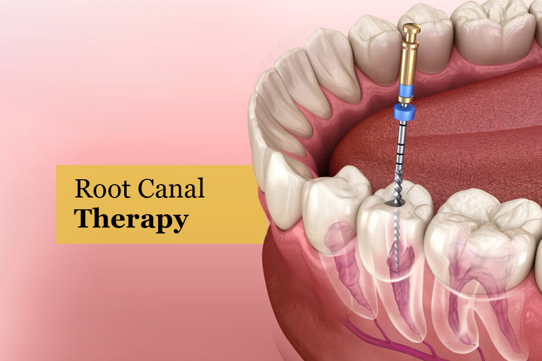 Illustration of a root canal file cleaning inside a tooth