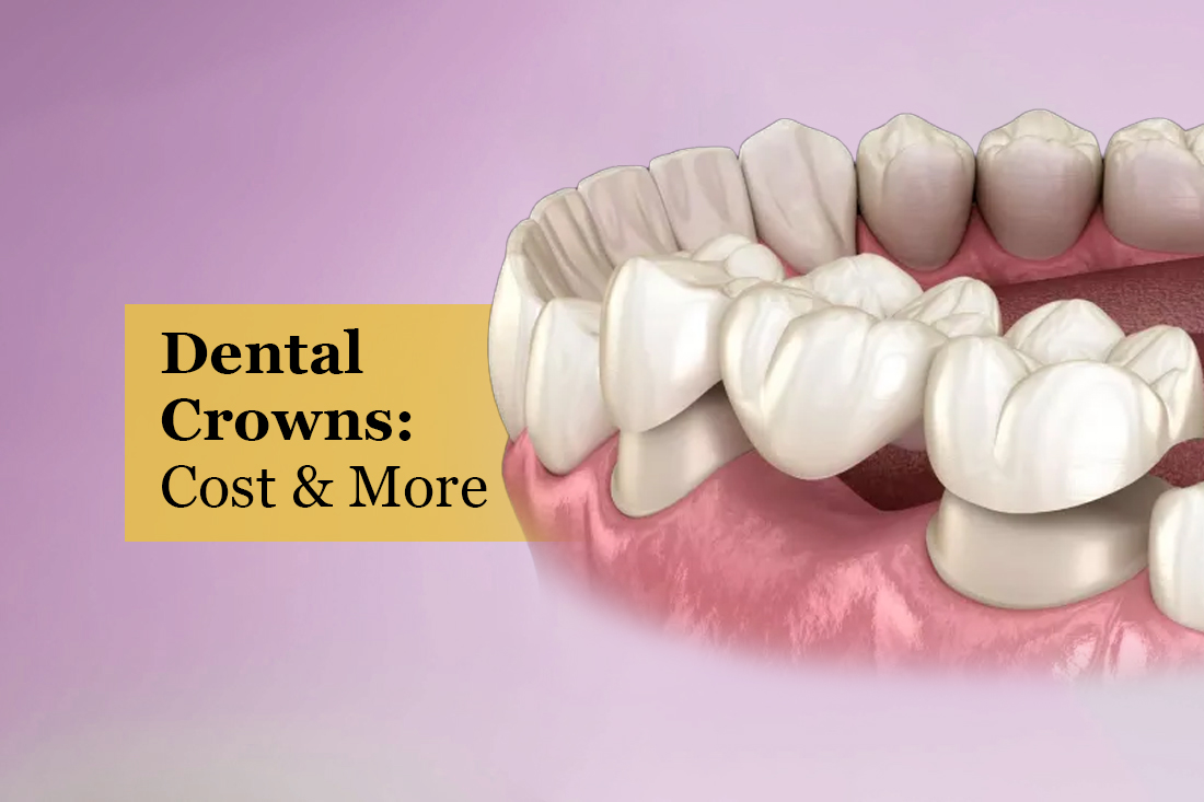 Dental crown being checked at Real Dentistry in Fullerton