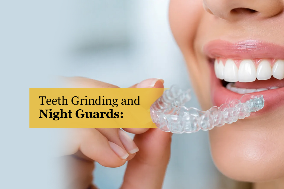 Custom night guard for teeth grinding at Real Dentistry