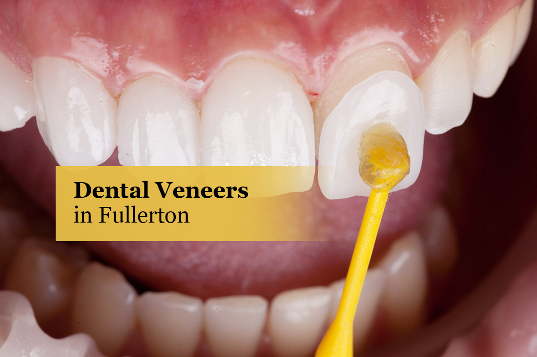 Dental Veneers in Fullerton: a porcelain veneer being bonded to a front tooth
