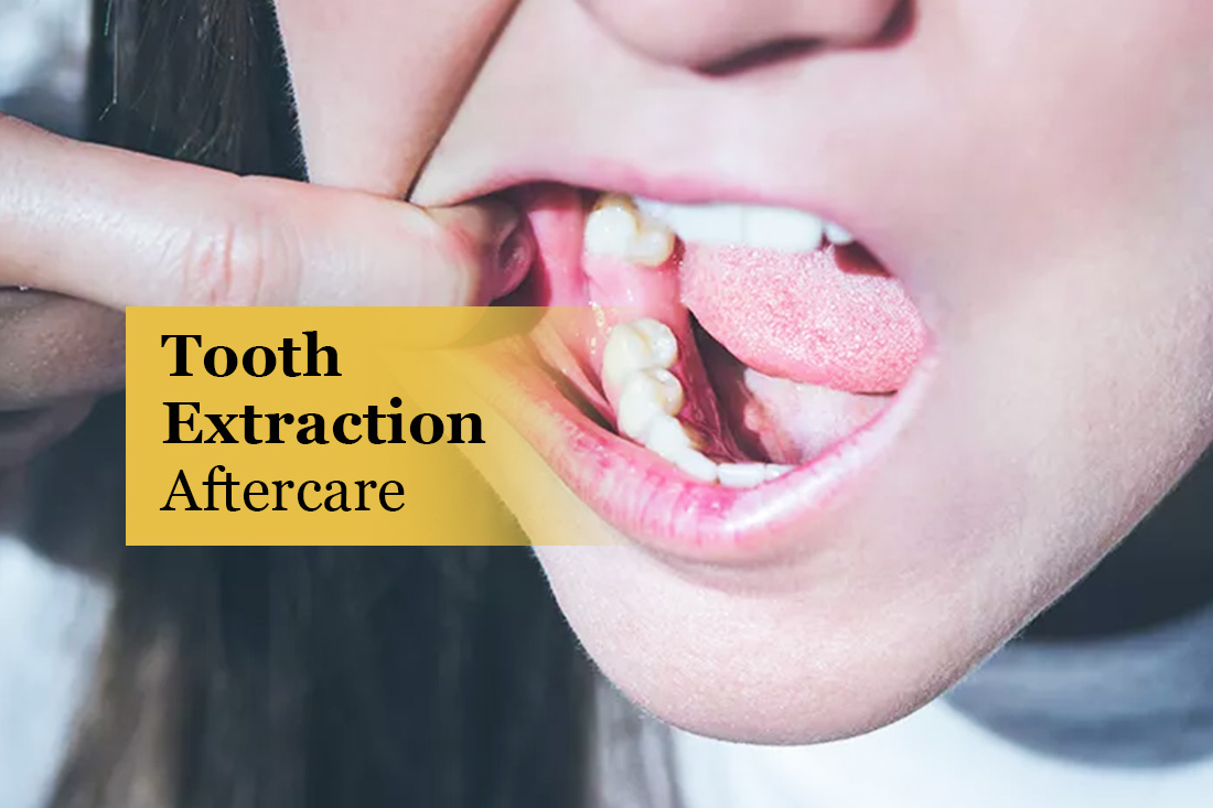 Tooth Extraction Aftercare: patient pulling back their cheek to show a healing extraction site