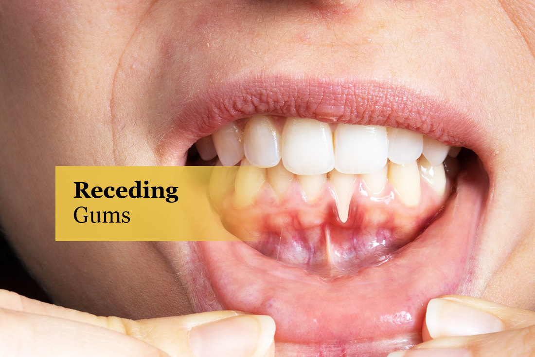 Receding Gums: close-up of lower teeth with gum recession exposing the roots