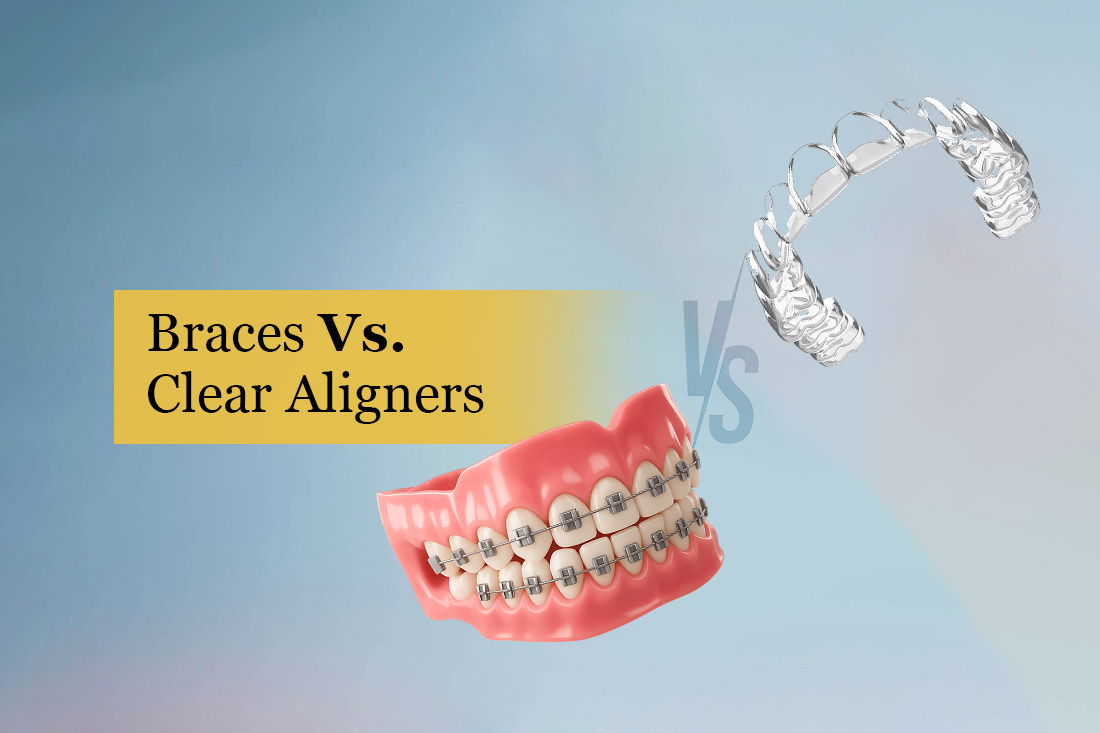 Braces vs. Clear Aligners: model with metal braces beside a clear aligner tray