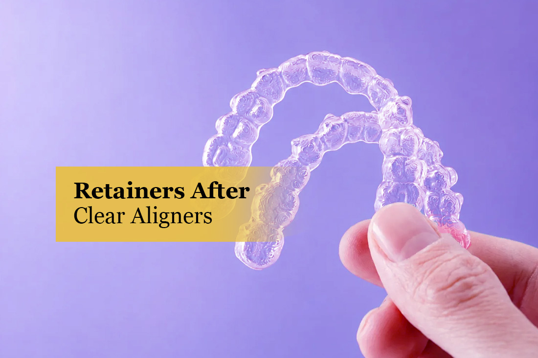 Image placeholder: Retainer care