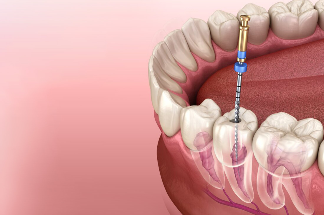 Root Canal Therapy at Real Dentistry in Fullerton, CA