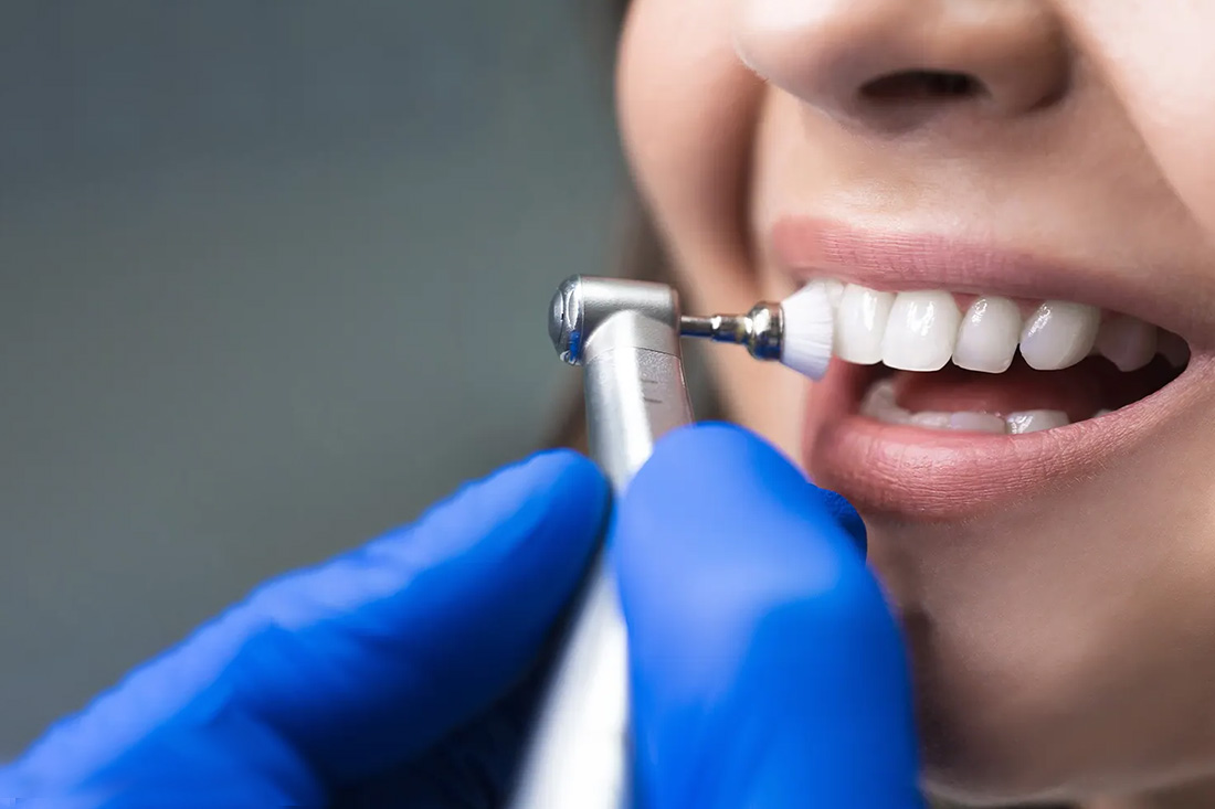 Teeth Cleaning at Real Dentistry in Fullerton, CA