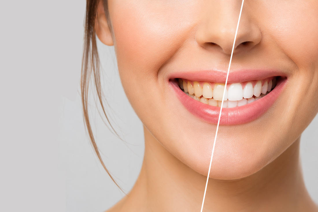Teeth Whitening at Real Dentistry in Fullerton, CA