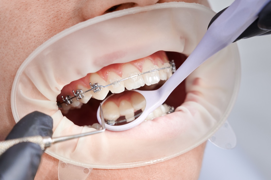 Orthodontic Treatment at Real Dentistry in Fullerton, CA