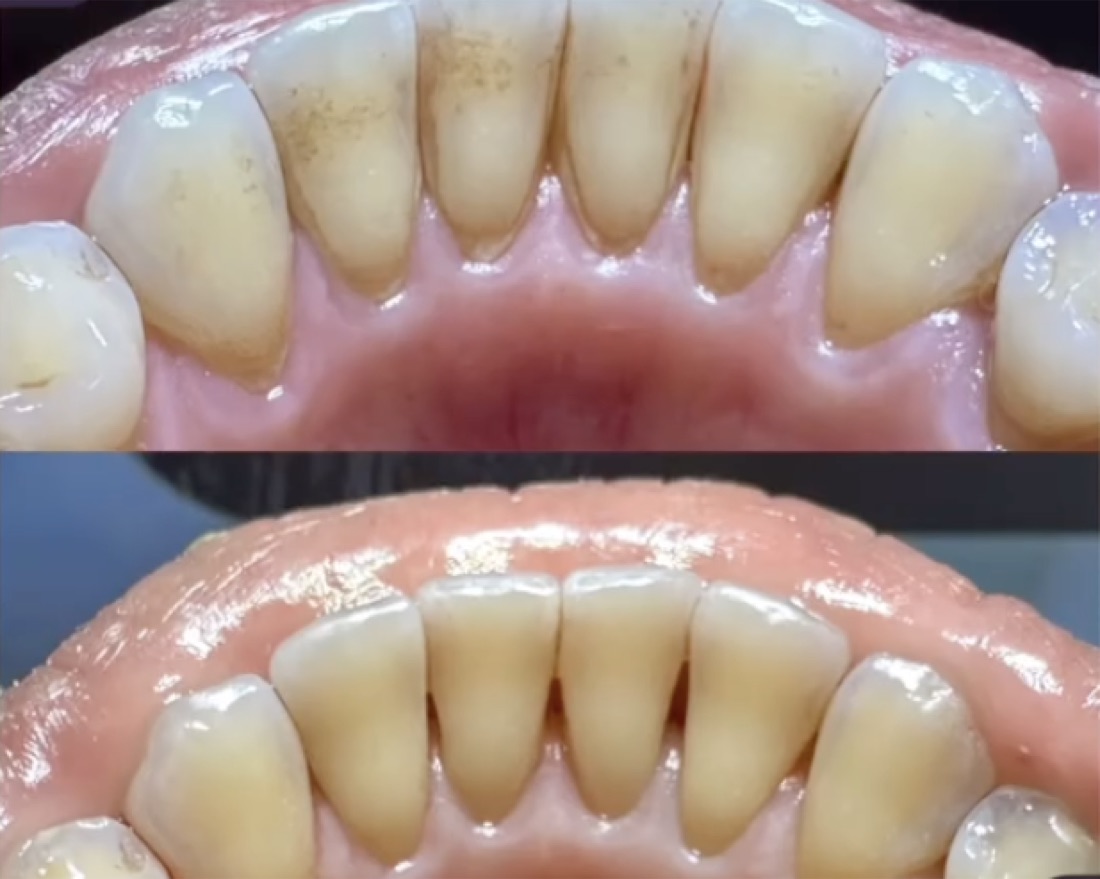 Before and after smile transformation