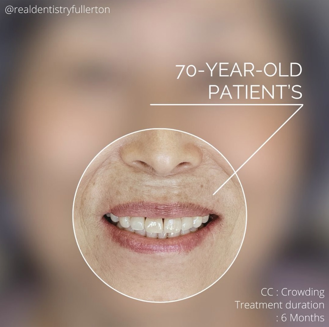 Before and after smile transformation