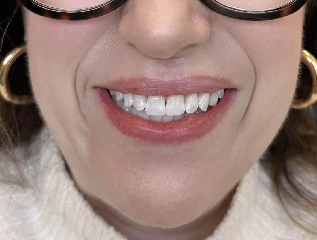 Before and after smile transformation