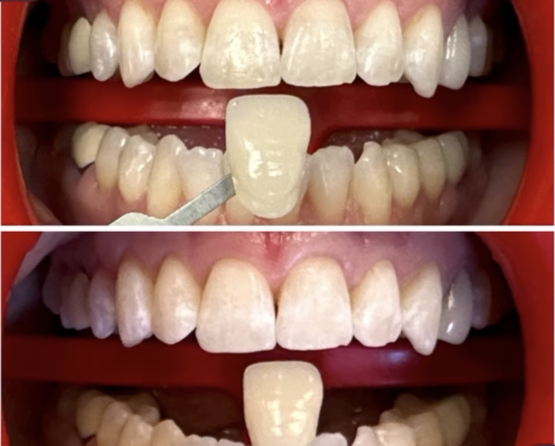 Before and after smile transformation