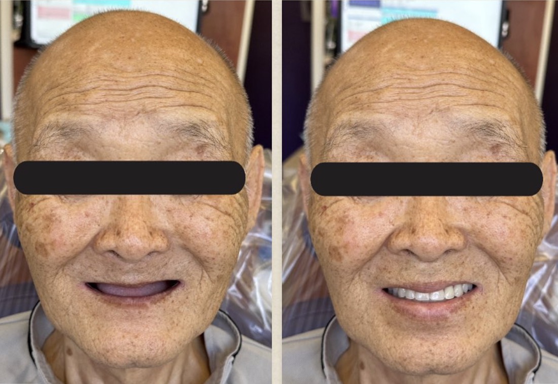 Before and after smile transformation