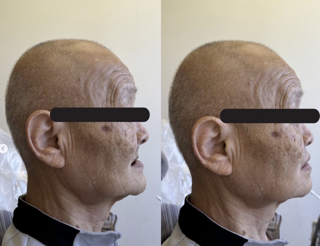 Before and after smile transformation