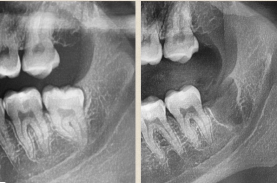 Before and after smile transformation