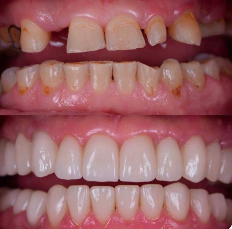 Before and after smile transformation