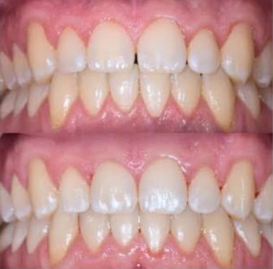Before and after smile transformation