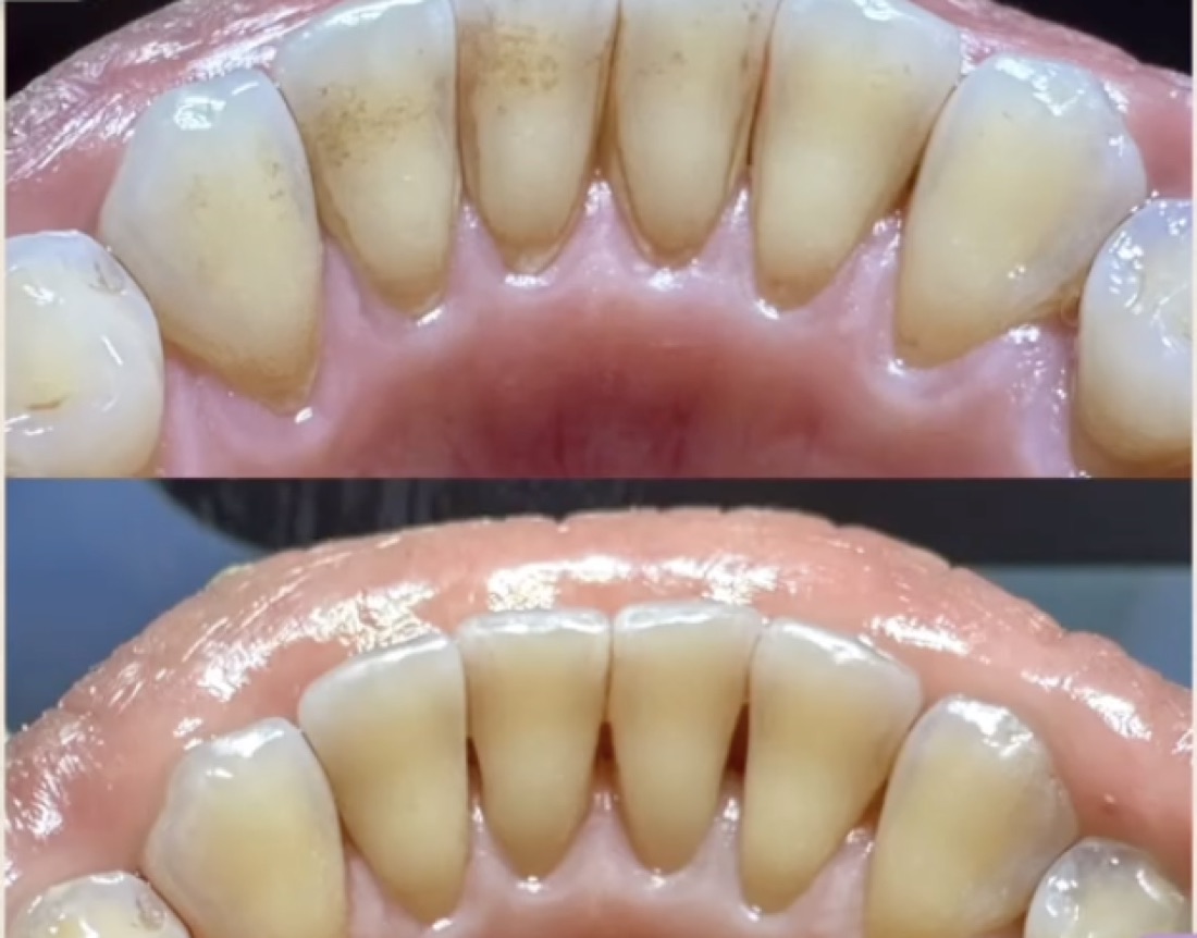 Before and after smile transformation