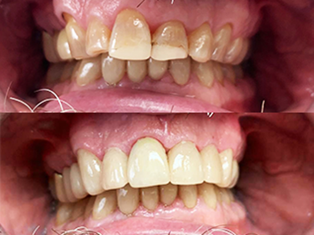 Before and after smile transformation