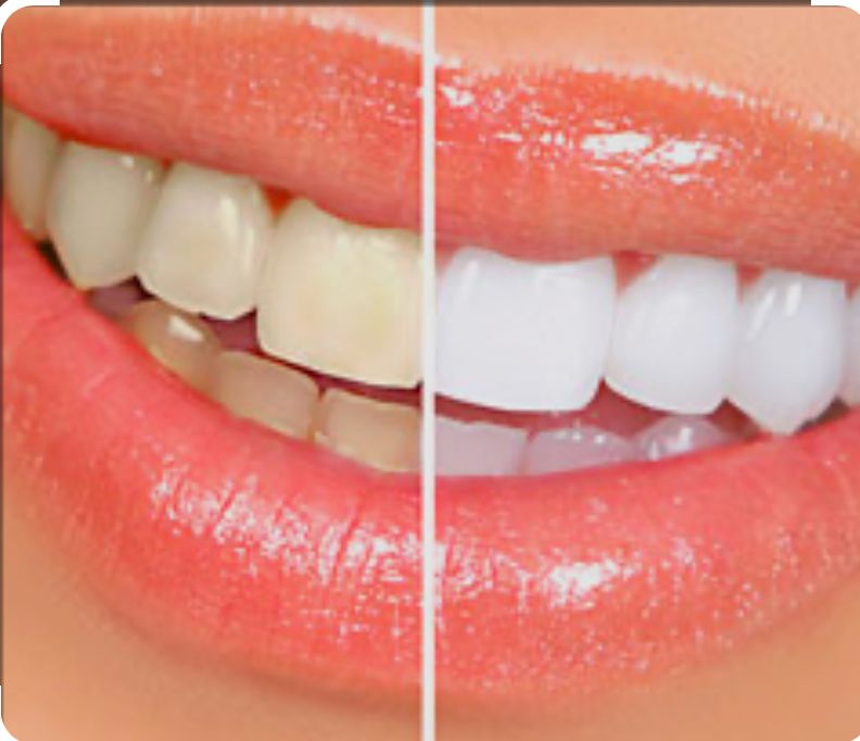 Before and after smile transformation
