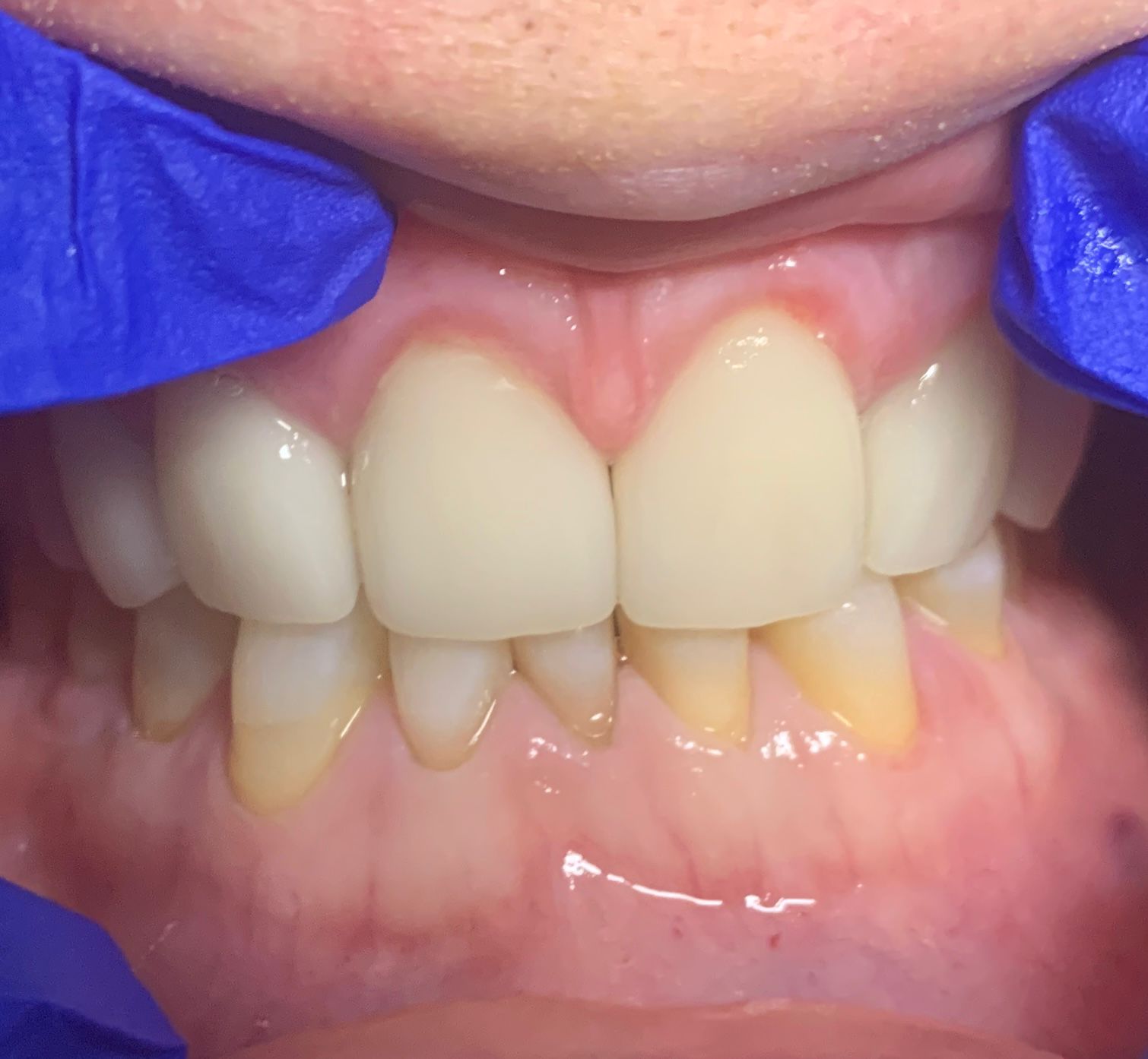 Before and after smile transformation