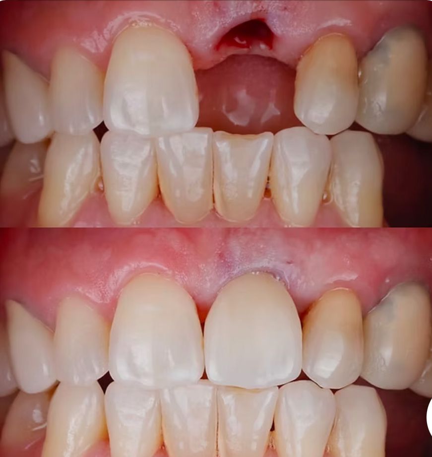 Before and after smile transformation
