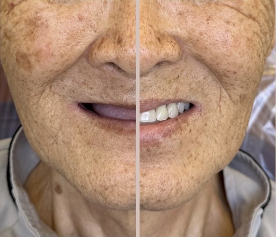 Before and after smile transformation