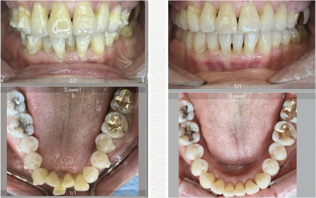 Before and after smile transformation