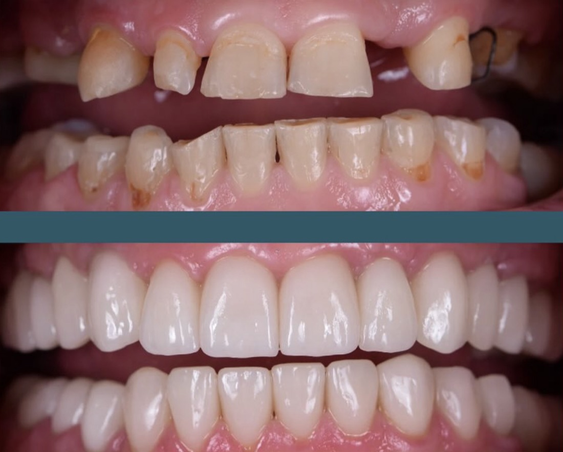 Before and after smile transformation