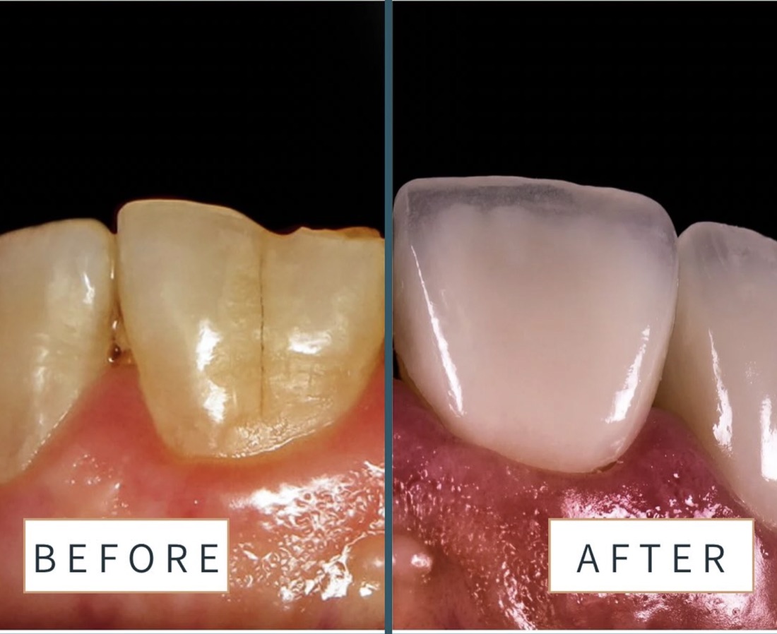 Before and after smile transformation