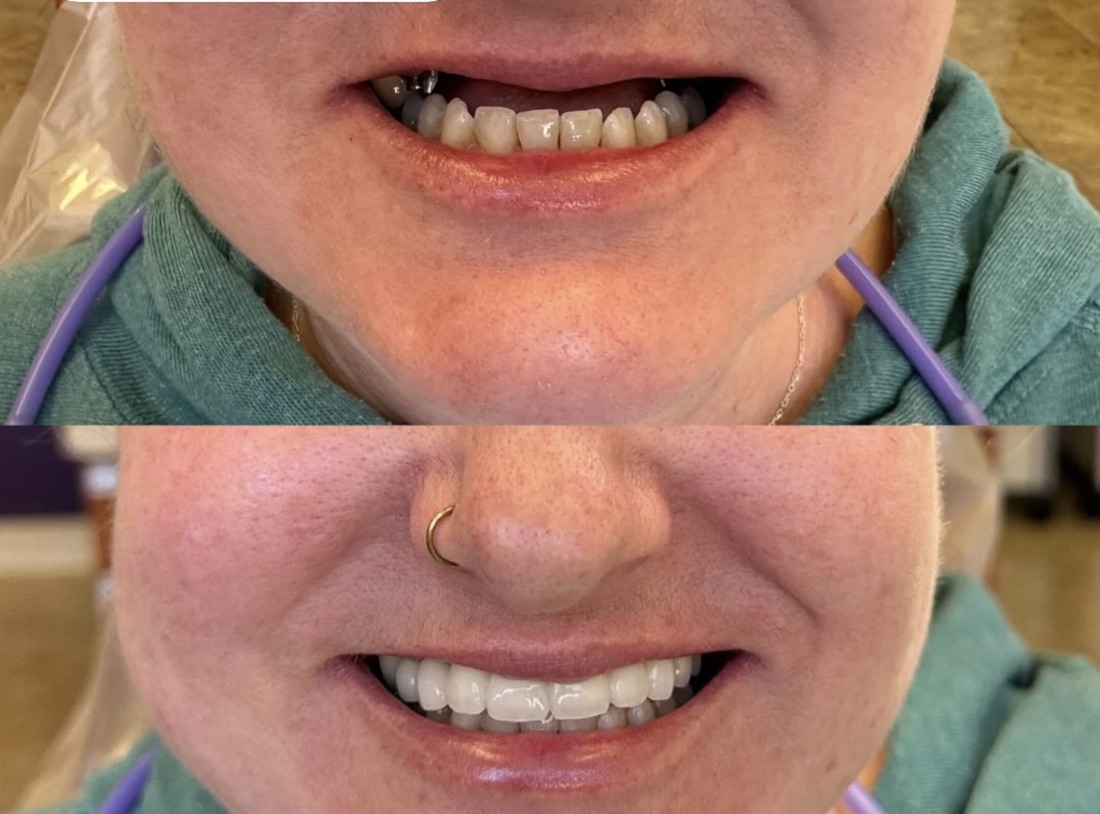 Before and after smile transformation