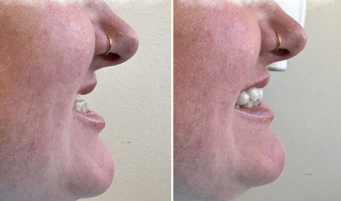 Before and after smile transformation
